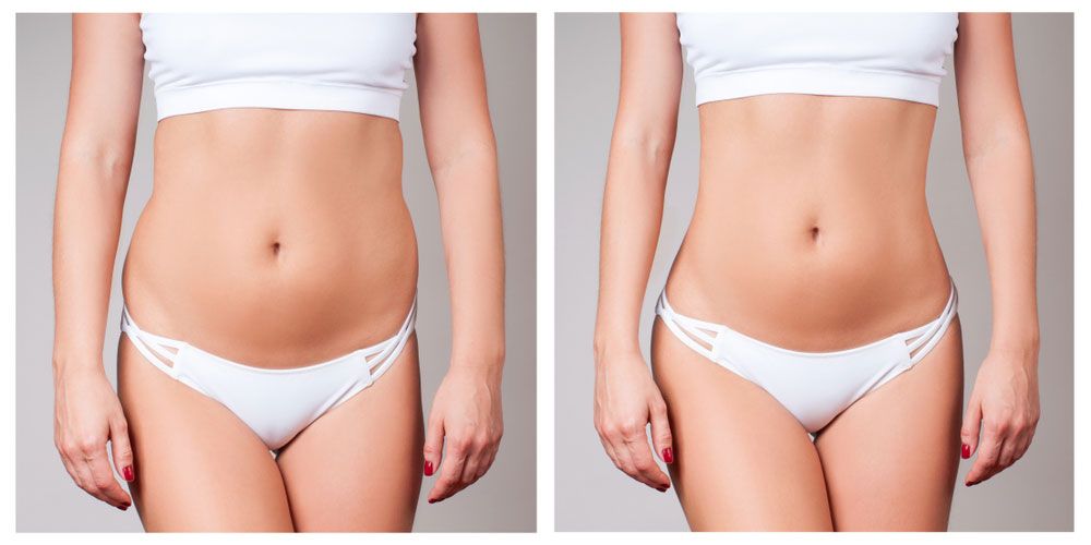 Before and after BodyTite